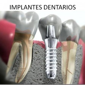 Implantologia Dental Madrid